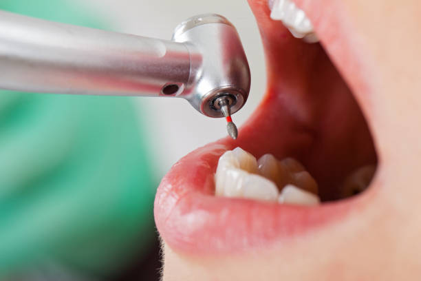 Best Emergency Tooth Extraction in Walkerton, IN